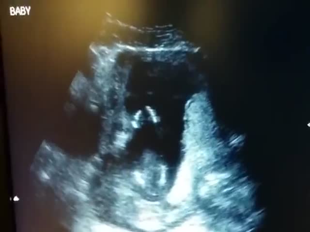 Unborn Baby Claps Hands inside Mommy's Womb  (VIDEO)