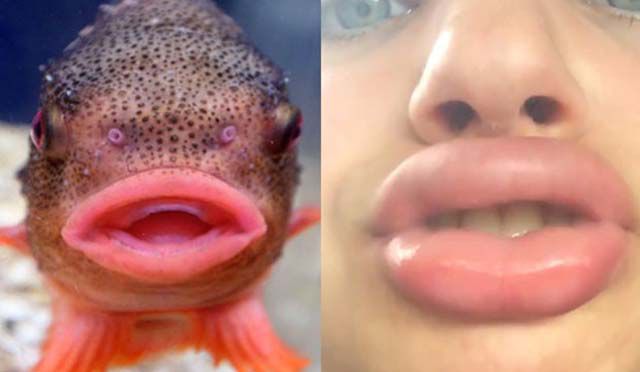 Kylie Jenner’s Lip Challenge Is Giving Girls “Fish Lips”