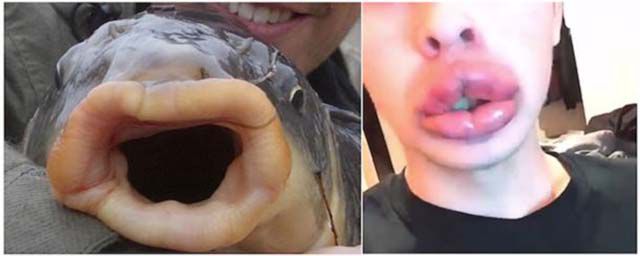 Kylie Jenner’s Lip Challenge Is Giving Girls “Fish Lips”