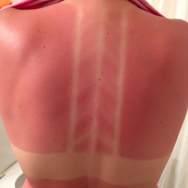 Suntan Fails That Make a Case for Using Suncream