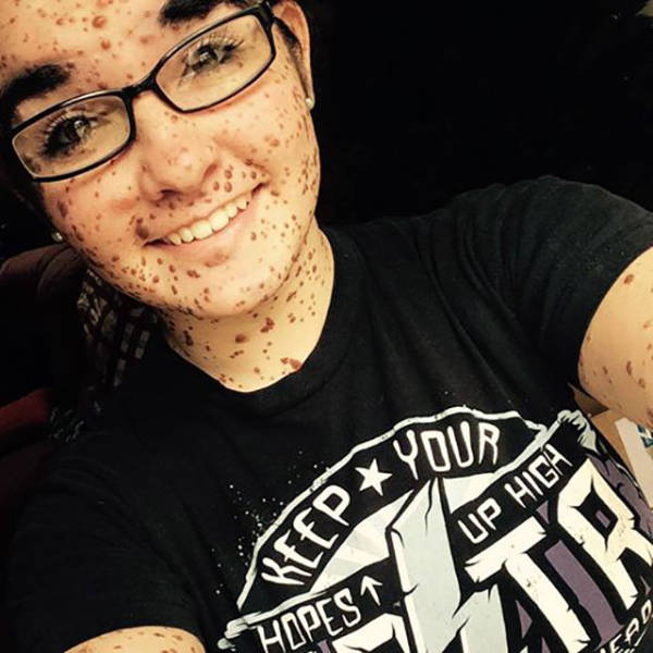 This Inspiring Teen Is Not Letting Her Birth Defect Stand in Her Way