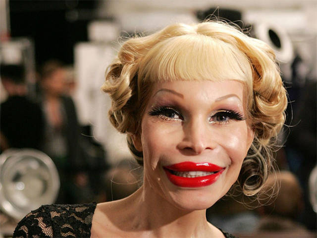 Plastic Surgery Fails That Will Make You Love Your Natural Looks