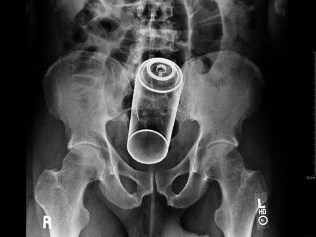 X-Rays of Objects Stuck in Really Strange Places