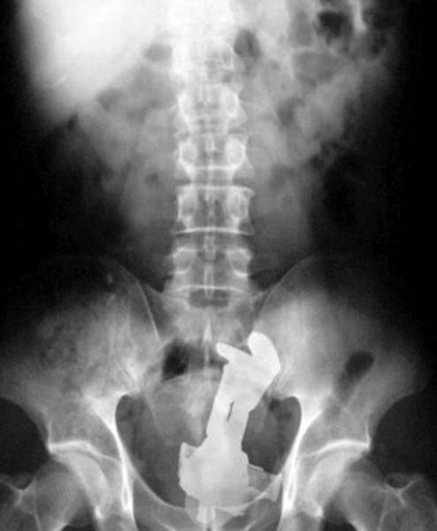 XRays Of Objects Stuck In Really Stran