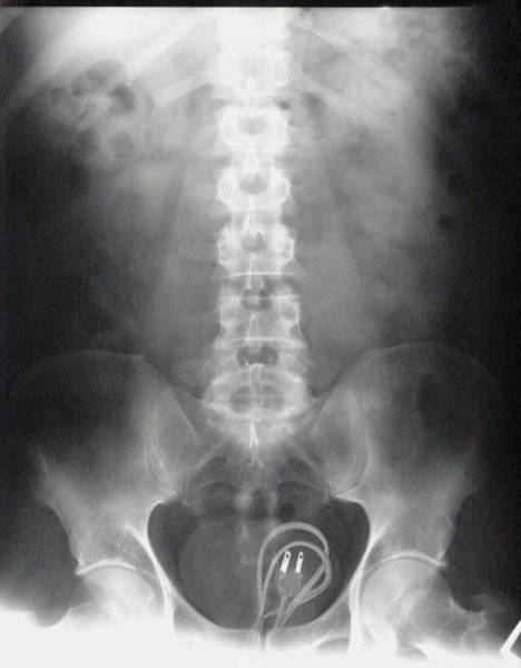 X-Rays of Objects Stuck in Really Strange Places (30 pics) - Izismile.com