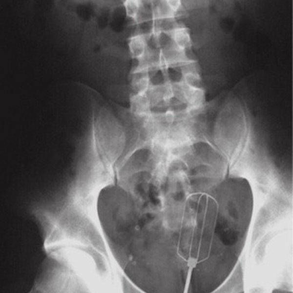 X Rays Of Objects Stuck In Really Strange Places 30 Pics
