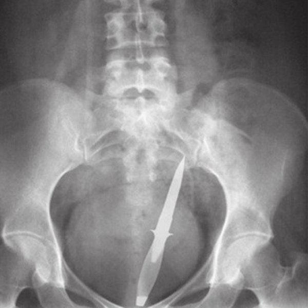 X-Rays of Objects Stuck in Really Strange Places