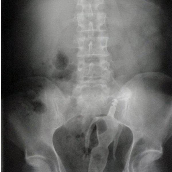 X-Rays of Objects Stuck in Really Strange Places