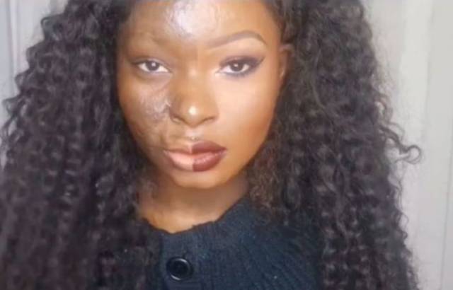 It May Seem Unbelievable But This Woman Has Burn Scars All Over Her Face