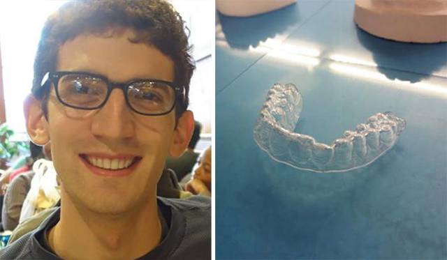 Guy 3D Prints His Own Braces Instead Of Paying Thousands Of Dollars