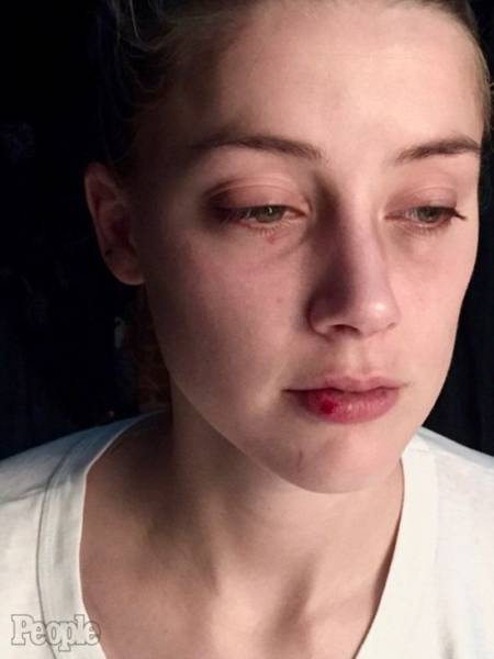 New Photos Of Johnny Depp’s Wife After He Attacked Her