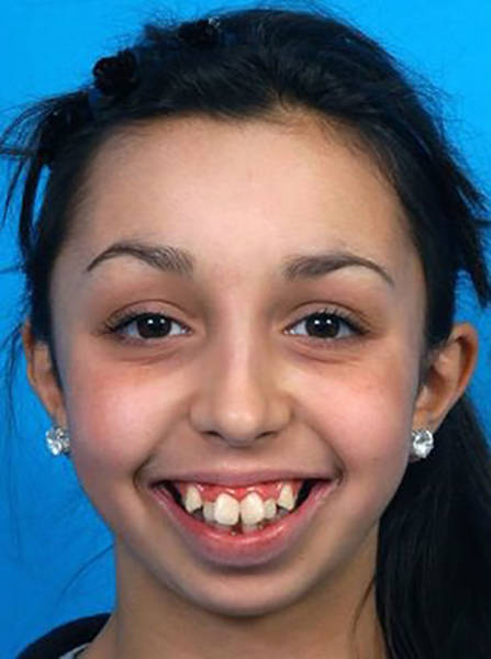 Girl Had A Life-Changing Jaw Surgery And Her Transformation Is Breathtaking