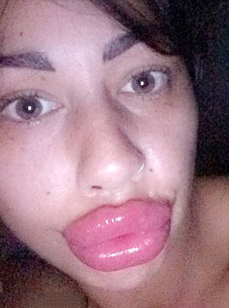 This Mum Has Already Huge Lips But She Wants Them Even Bigger