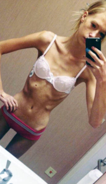 Anorexic Girl Who Was Given Only Days To Live Fights Her Way Out Of A Terrible Disease