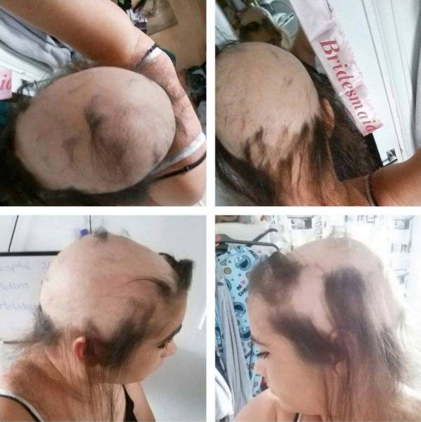 A Girl Was So Unhappy In Her Relationship That It Cost Her Her Hair