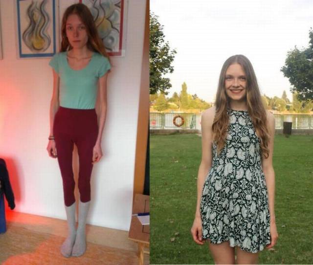 Anorexic Girl Was Only Several Days Away From Death But Managed To Recover 6 Pics