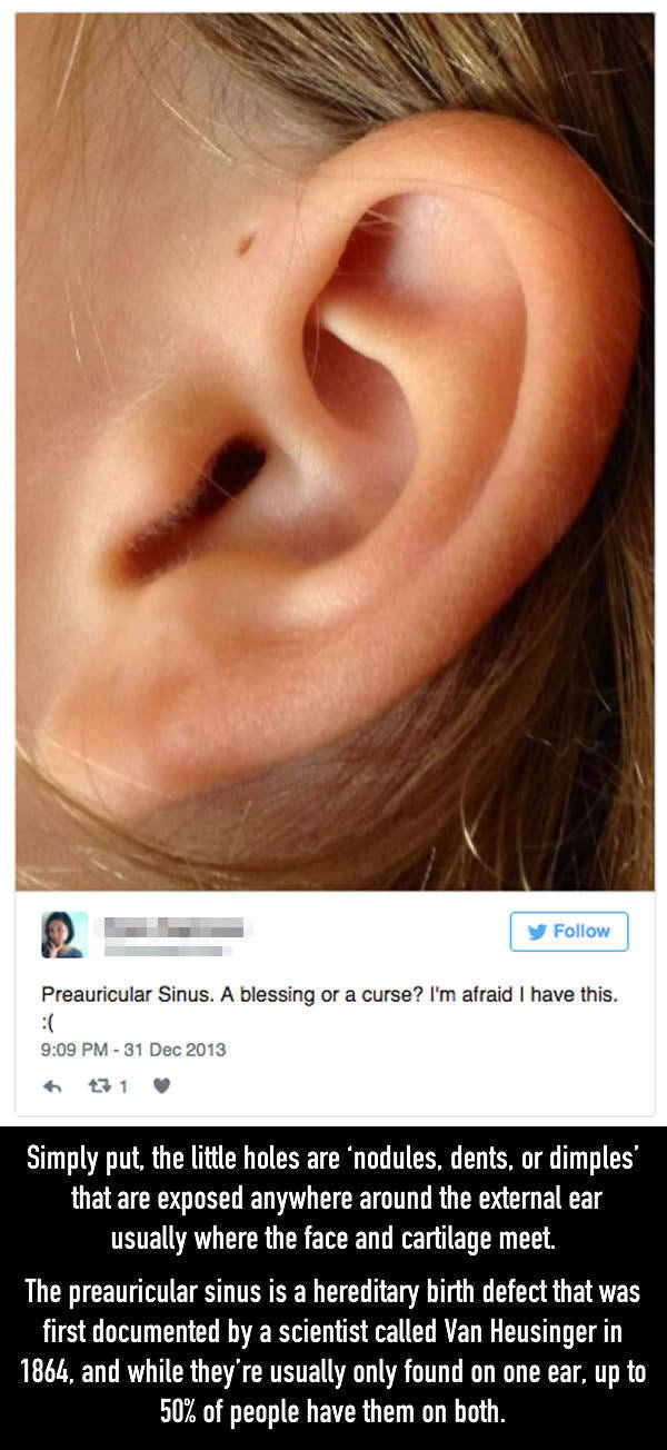 Have You Ever Wondered Why Some People Have These Little Holes Above Their Ears?
